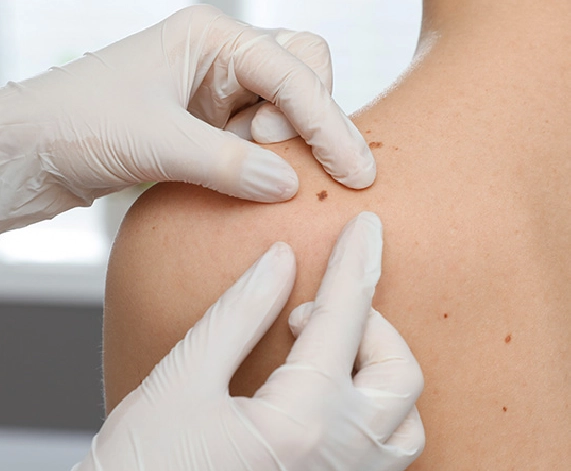 Safe and Scar-Free Mole Removal by Specialists 